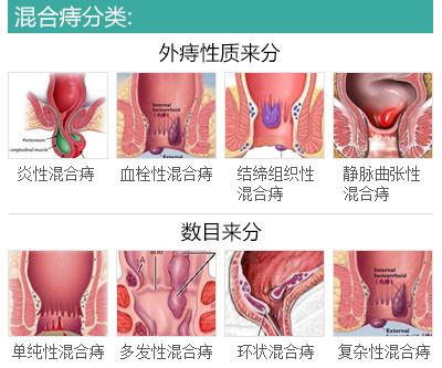 混合痔分类